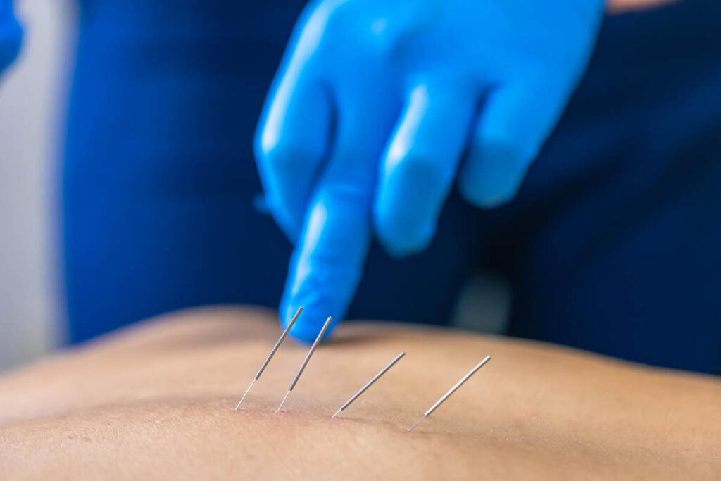 Dry Needling Treatment Fishers Relieve Pain and Enhance Mobility