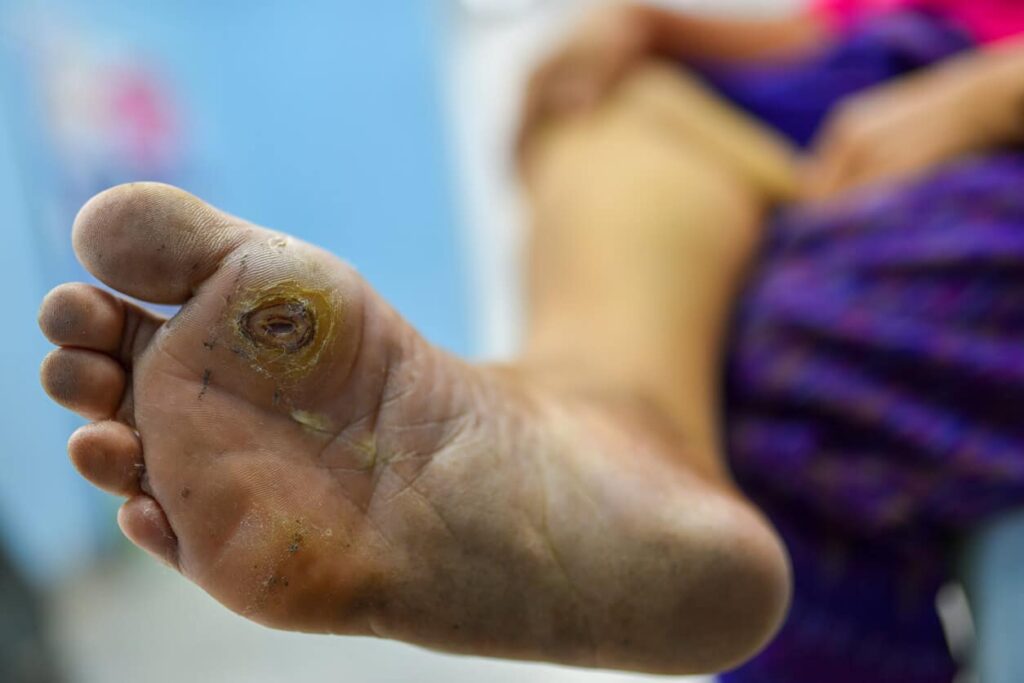 Orthopedic Treatment for Diabetic Gangrene Advanced Care, Prevention, and Recovery