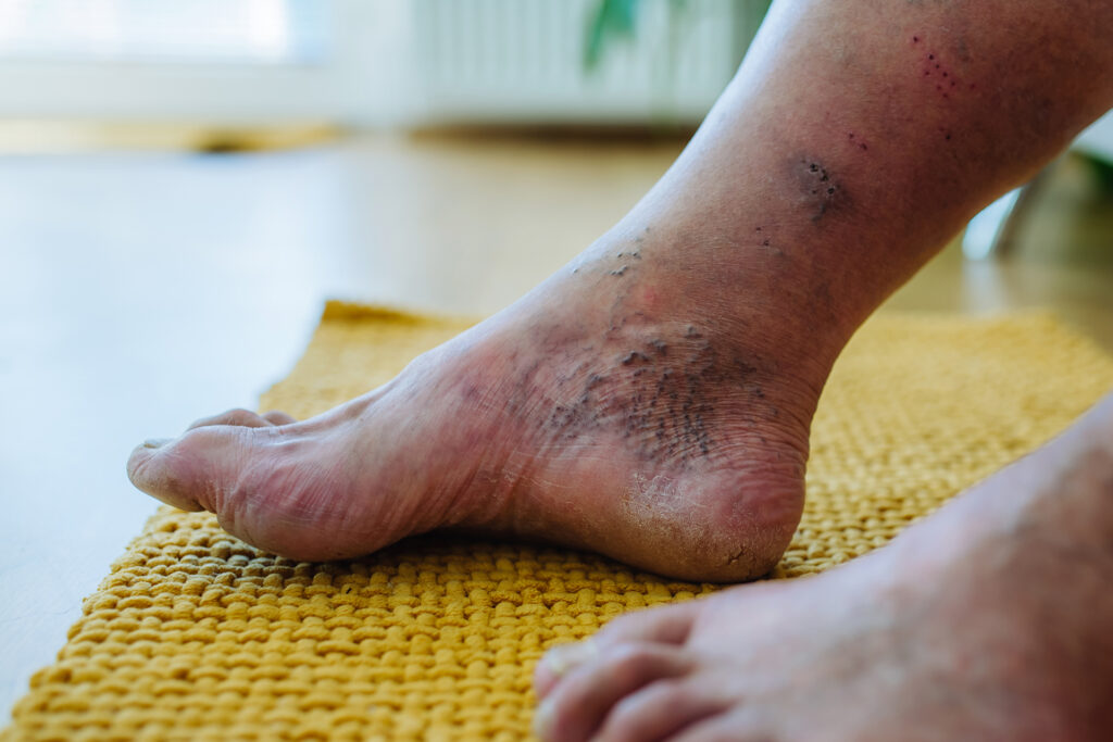 Mastering Comprehensive Diabetic Foot Ulcer Management A Complete Guide for Patients and Healthcare Providers